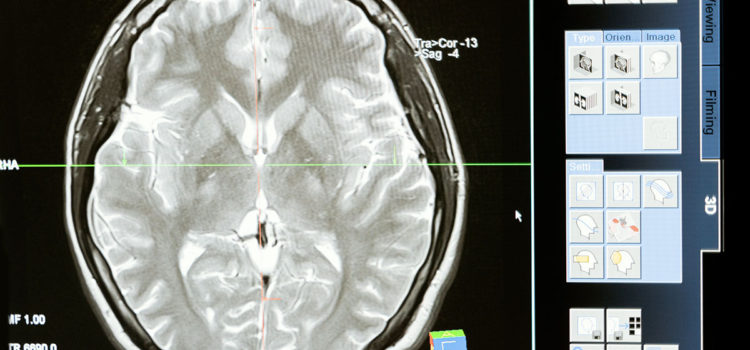 Ученые научили нейросеть выявлять деменцию на ранней стадии за один день | РБК Тренды